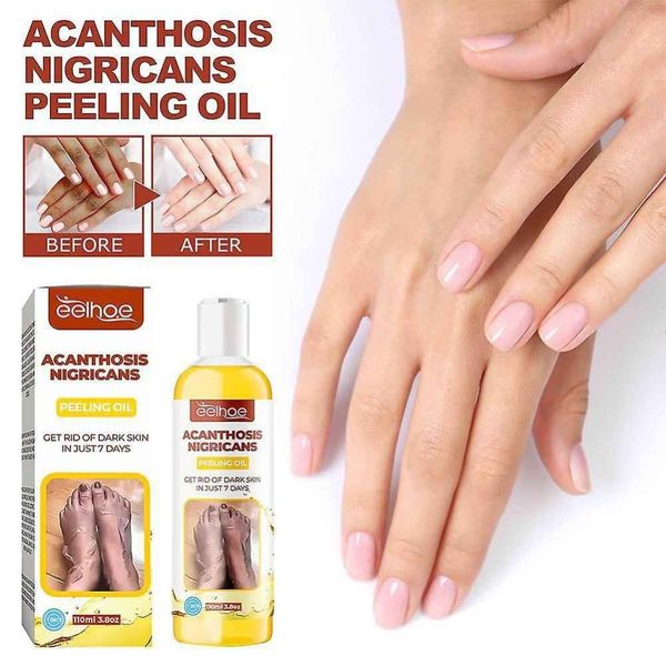 روغن لایه‌بردار از بین برنده تیرگی پوست آکانتوز نیگریکانس Acanthosis Nigri