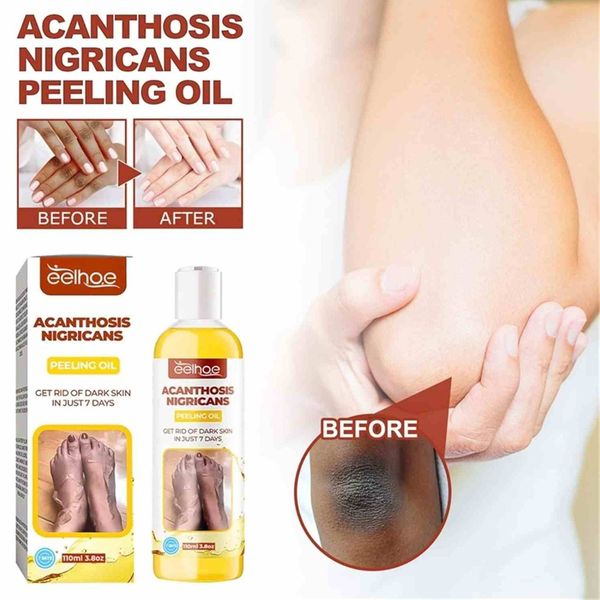 روغن لایه‌بردار از بین برنده تیرگی پوست آکانتوز نیگریکانس Acanthosis Nigri