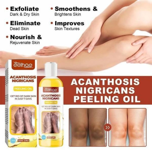 روغن لایه‌بردار از بین برنده تیرگی پوست آکانتوز نیگریکانس Acanthosis Nigri
