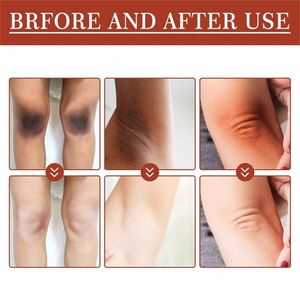 فروش اینترنتی روغن لایه‌بردار از بین برنده تیرگی پوست آکانتوز نیگریکانس Acanthosis Nigri