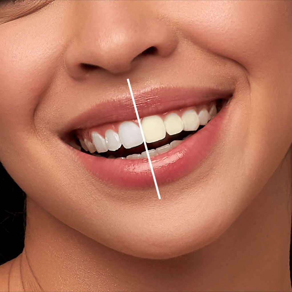 خرید آنلاین سفید کننده دندان مدل Vi-ONE