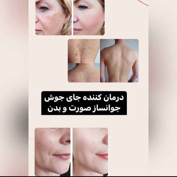 سرم سفید کننده آلفا فوری و قوی بیکینی