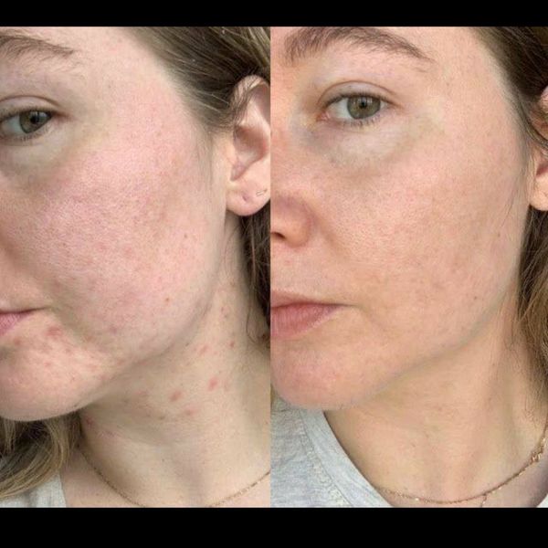 سرم سفید کننده آلفا فوری و قوی بیکینی