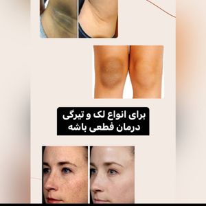 خرید انلاین سرم سفید کننده آلفا فوری و قوی بیکینی