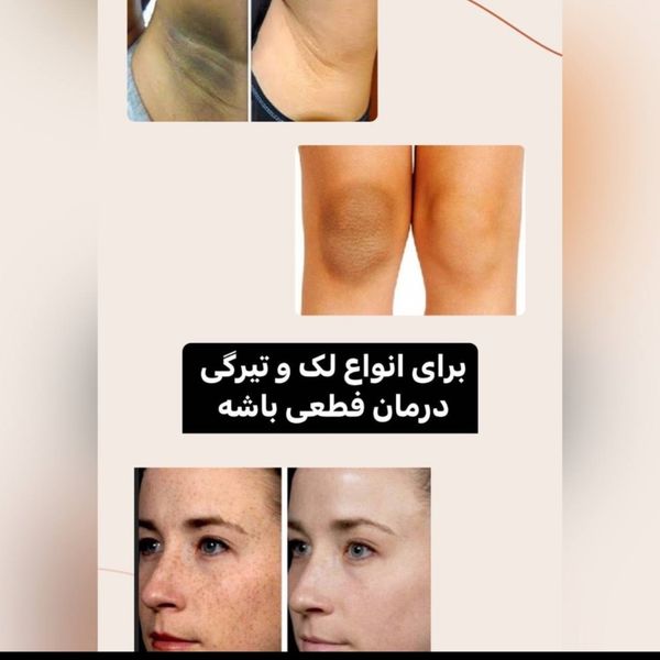 سرم سفید کننده آلفا فوری و قوی بیکینی