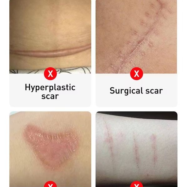 ژل کرم ترمیم کننده جای جوش و اسکار لانبنا (لنبنا) LANBENA مدل SKIN CARE